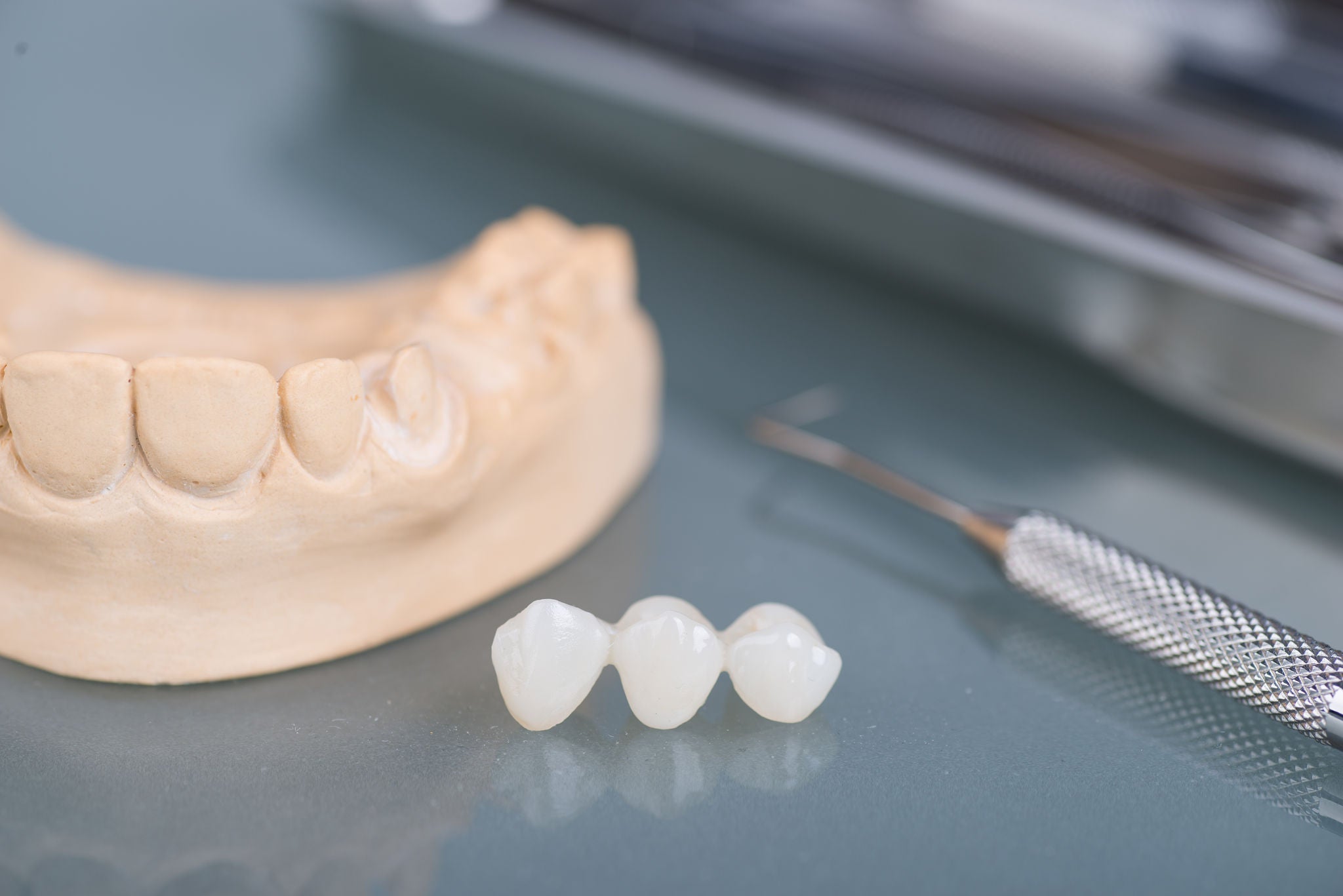Diferencia entre puente dental e implante dental