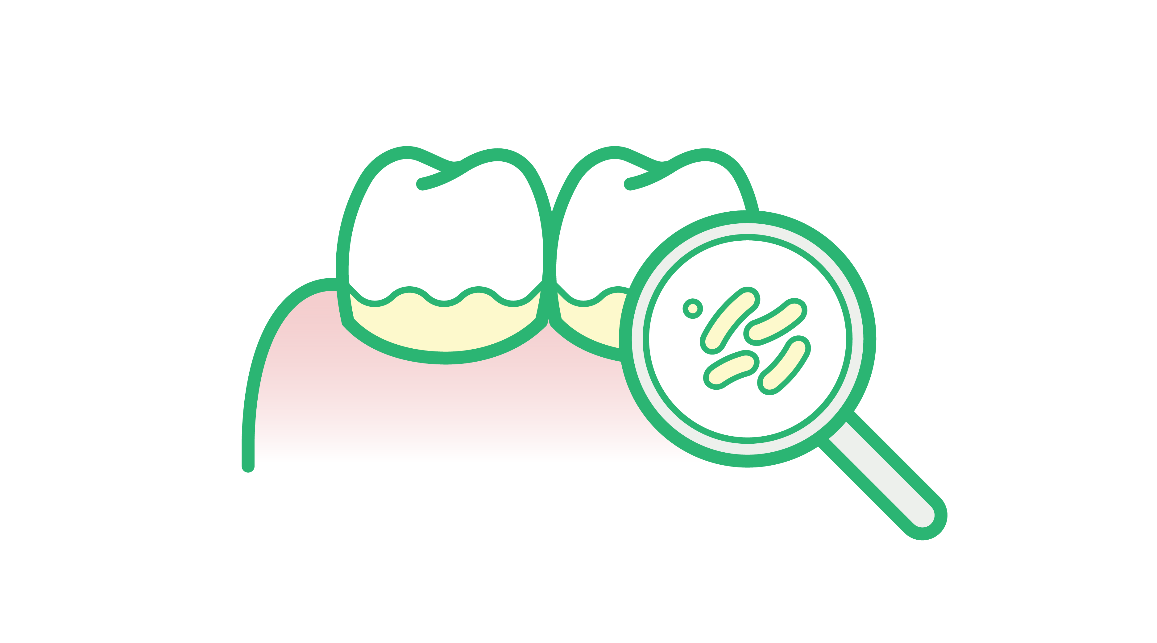 Ilustración de dos dientes con acumulación de placa bacteriana