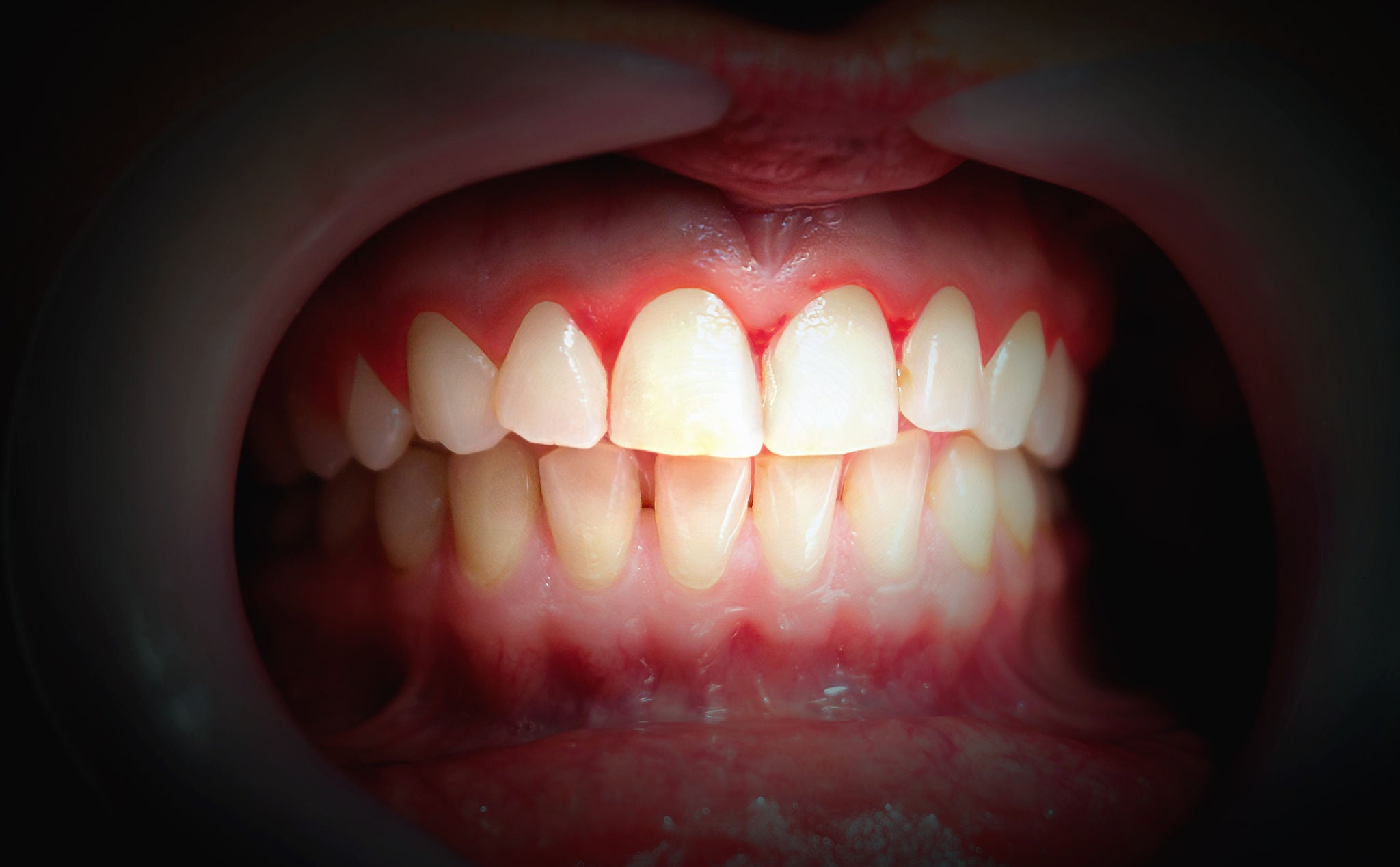 Mouth with bleeding gums on a dark background. Close up.