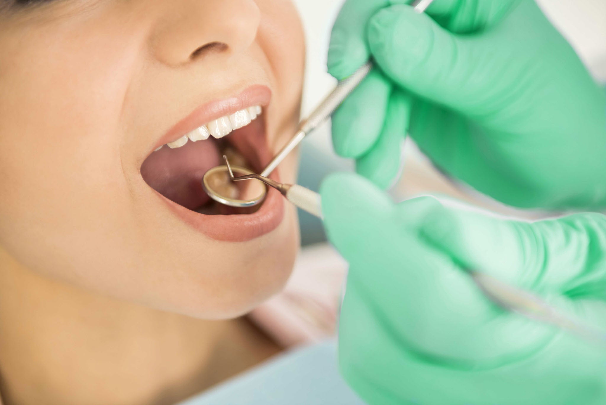 Beneficios de la limpieza dental profesional