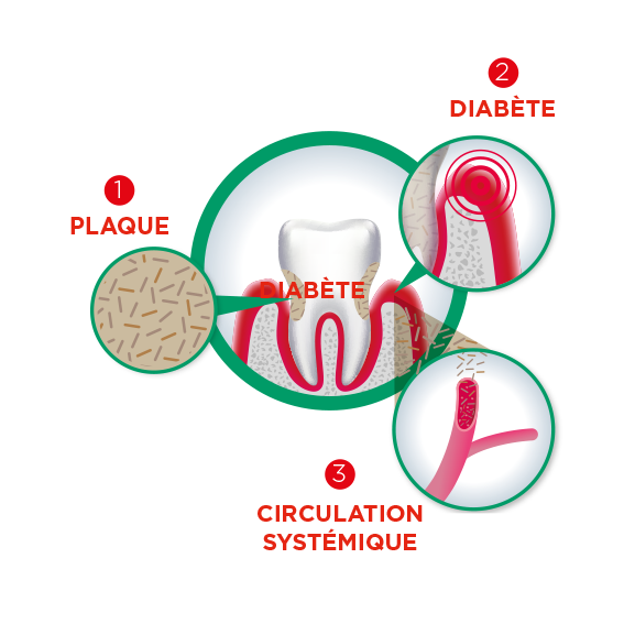 dents et diabète