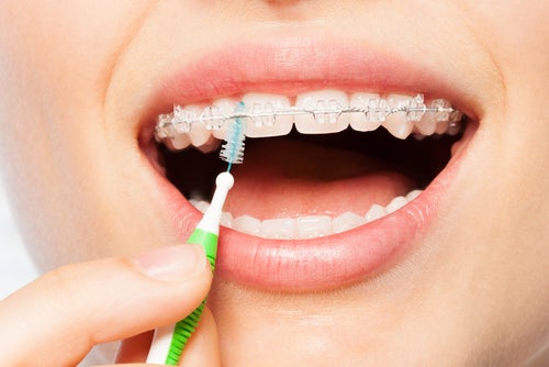 Quelle est la meilleure façon de nettoyer un protège-dents ? 