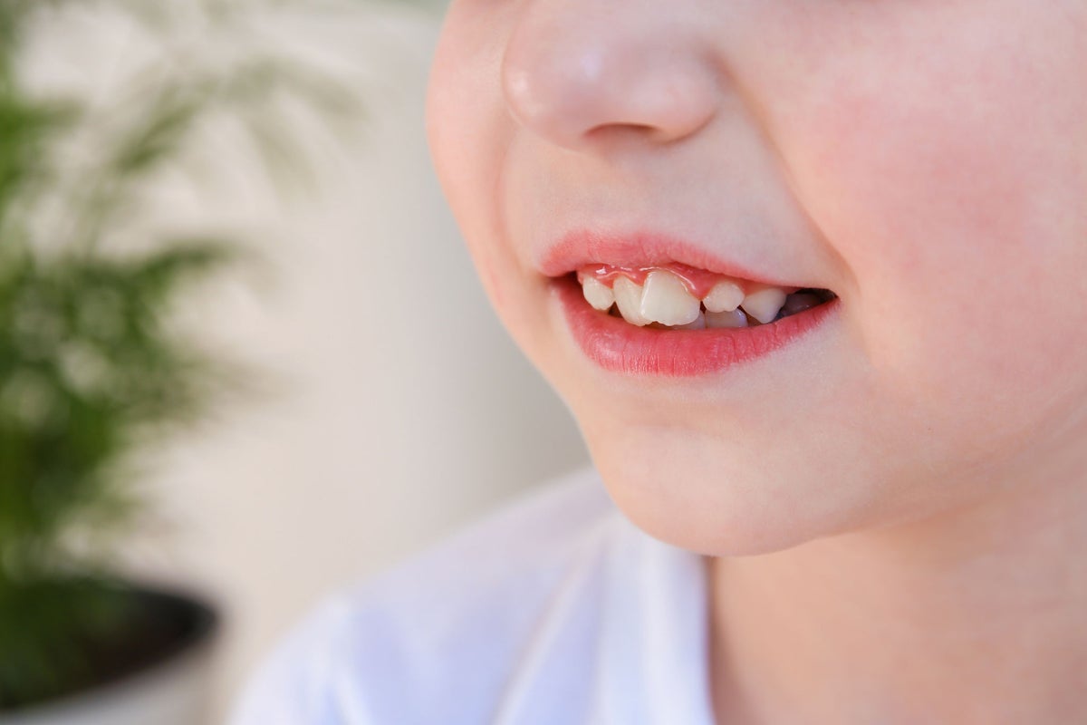 Affollamento dei Denti: Cosa Fare in Questi Casi
