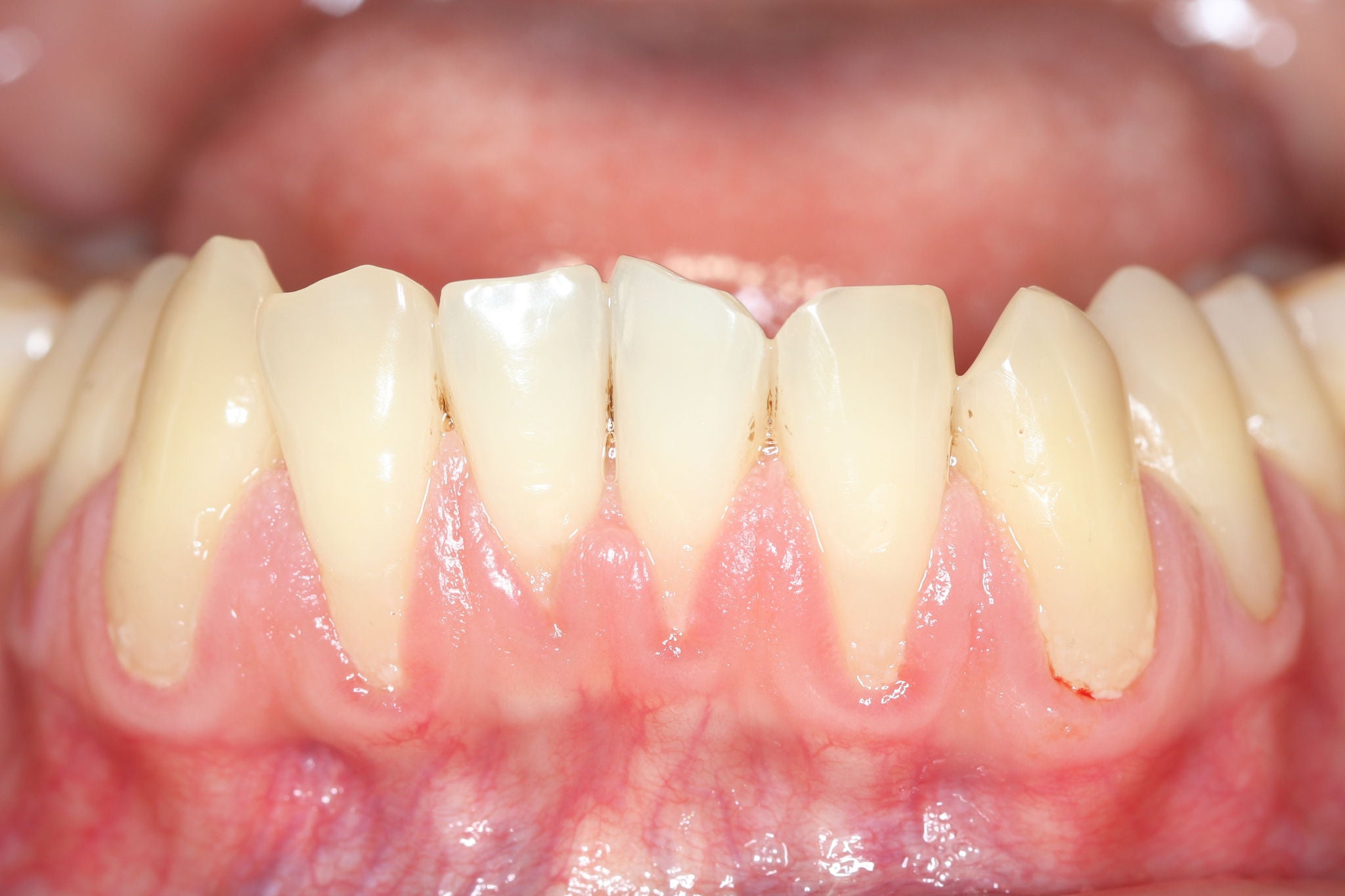 Gingival recession, also known as receding gums, is the exposure in the roots of the teeth caused by a loss of gum tissue and/or retraction of the gingival margin from the crown of the teeth