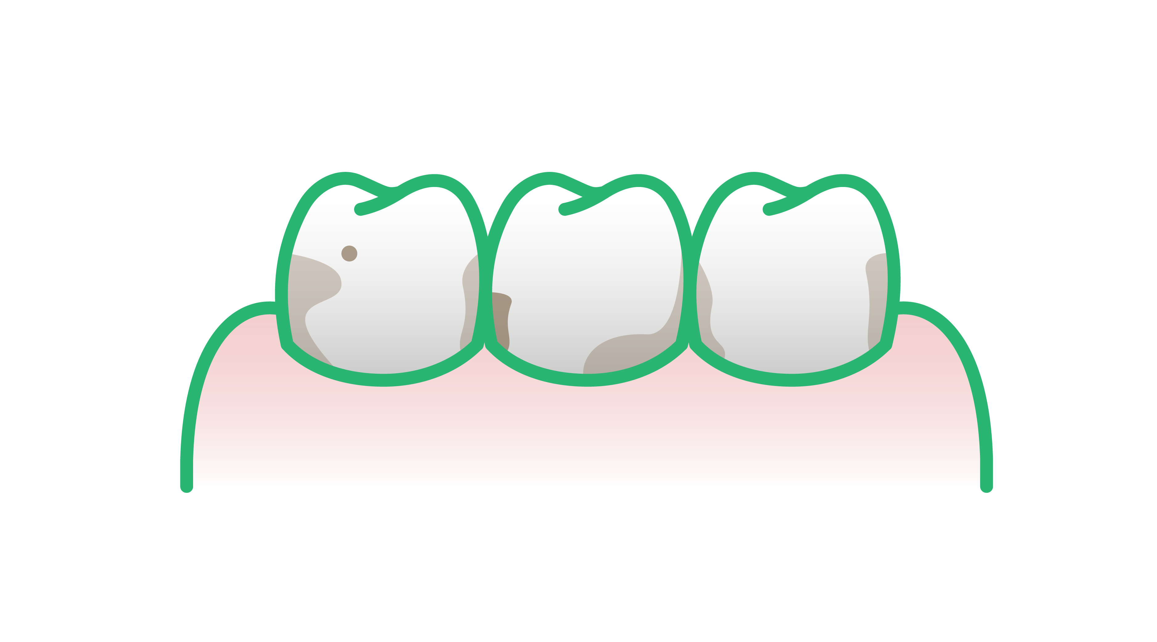 Abbildung von verfärbten Zähnen