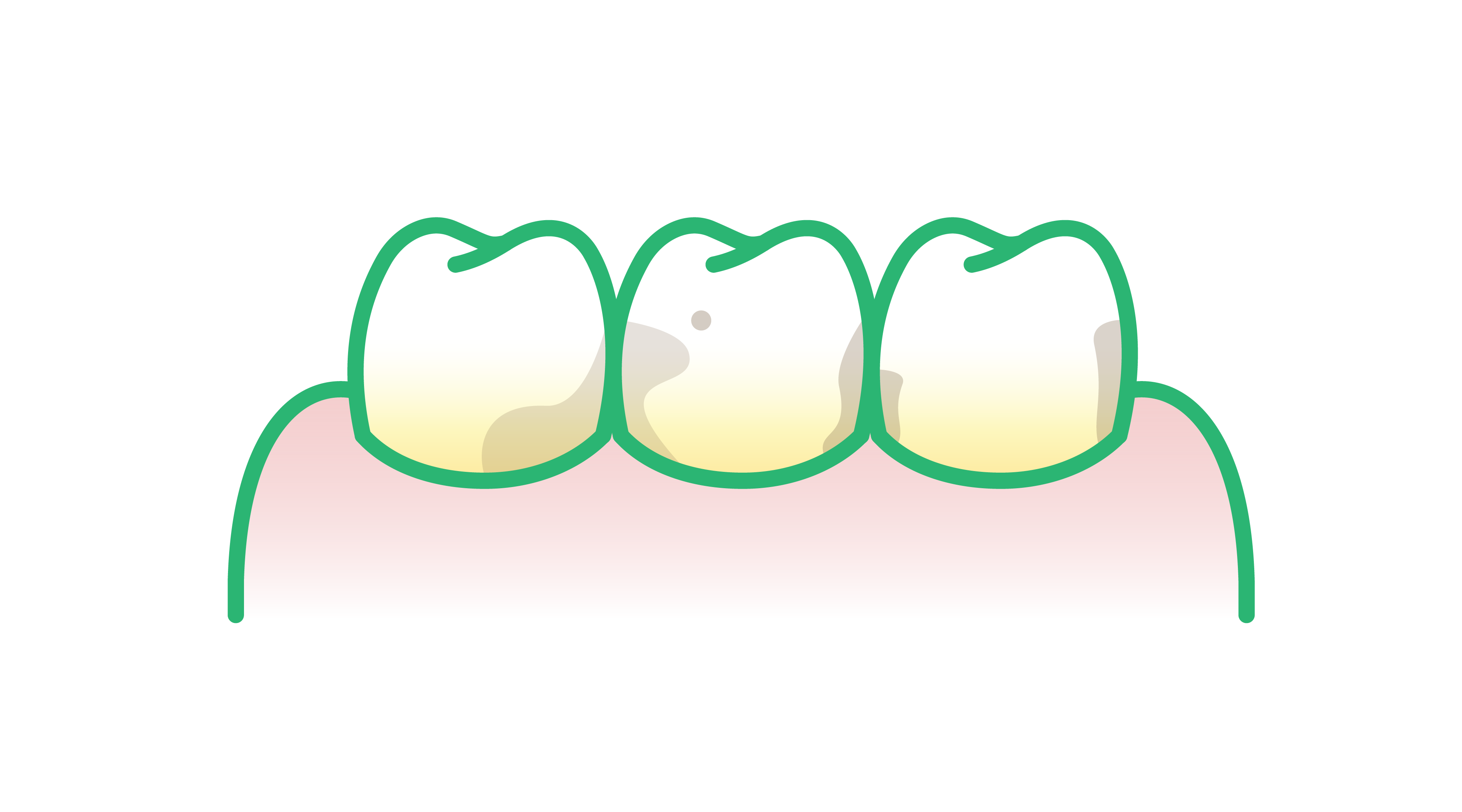 Comment se débarrasser du tartre sur les dents ?