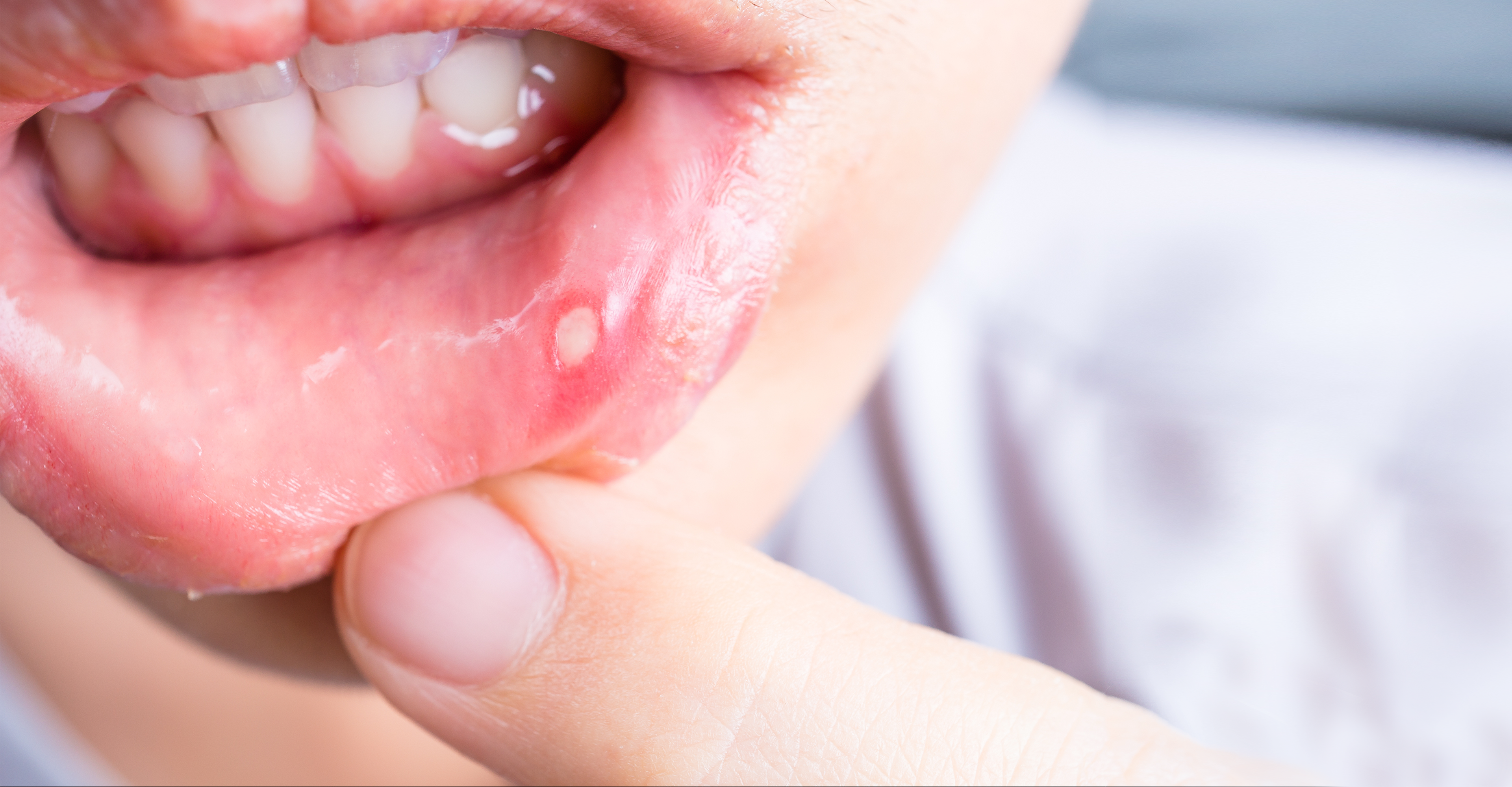 Close up of Asian woman with aphtha on lip