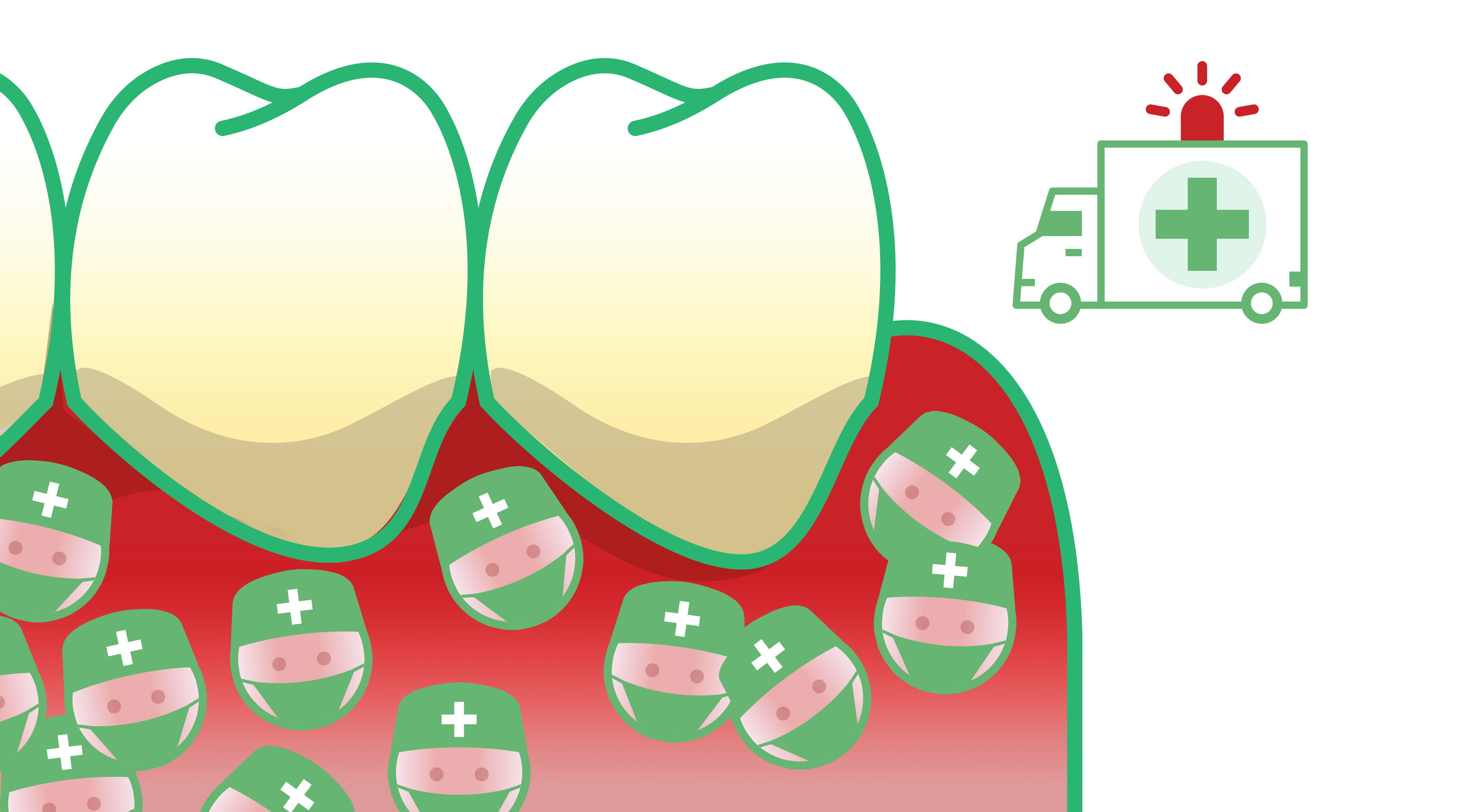 Gingivitis zur Parodontitis