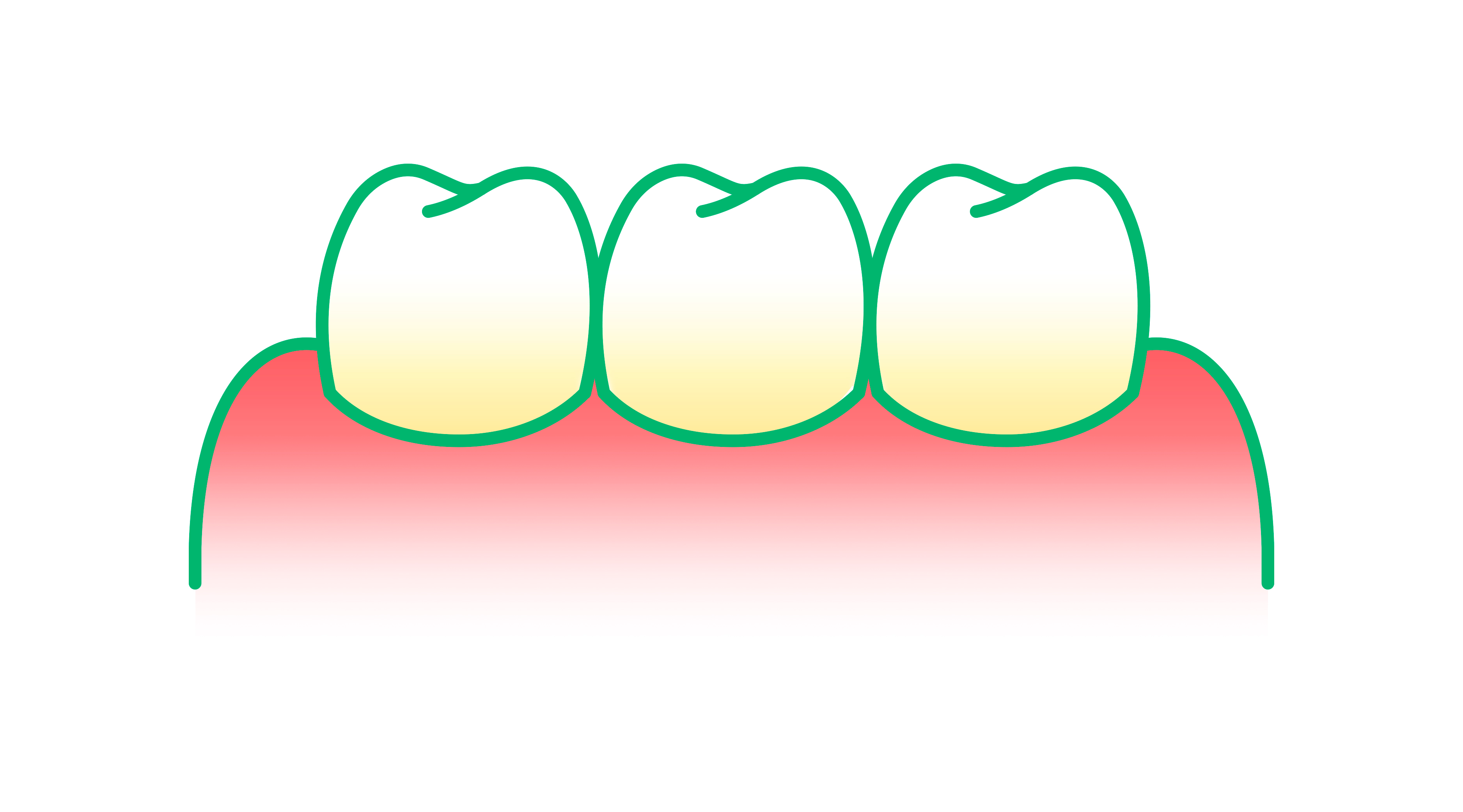 Illustration von entzündetem Zahnfleisch 