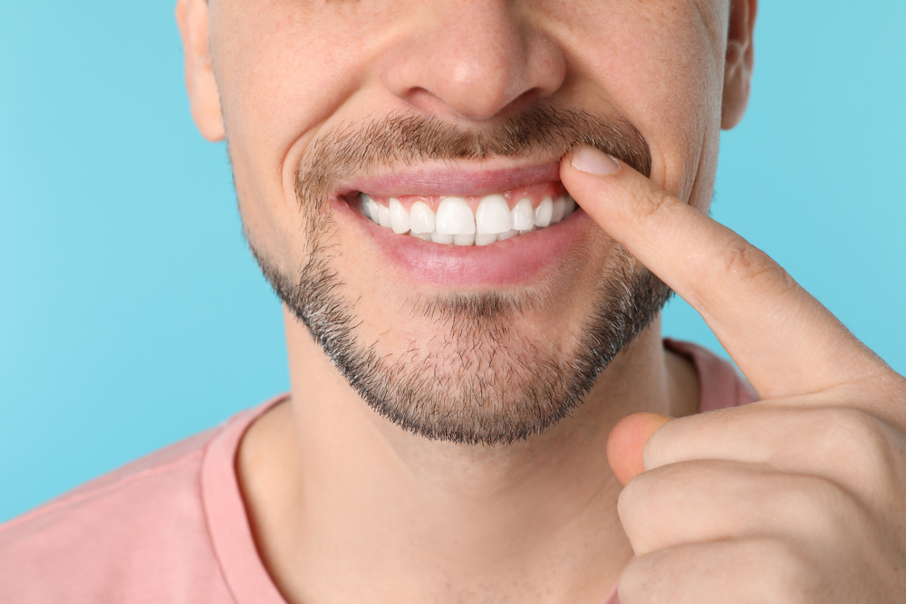 Abfraction Dentale: tutte le cause e i rimedi | GUM