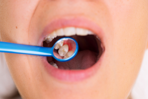 Denti storti: cause, rimedi e pulizia | GUM®