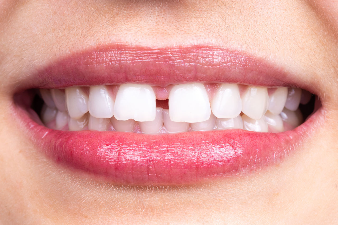 Diastema Dentale: da cosa è causato e come intervenire