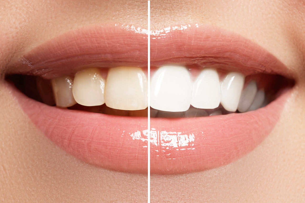 Lo sbiancamento dentale: cos’è e come funziona