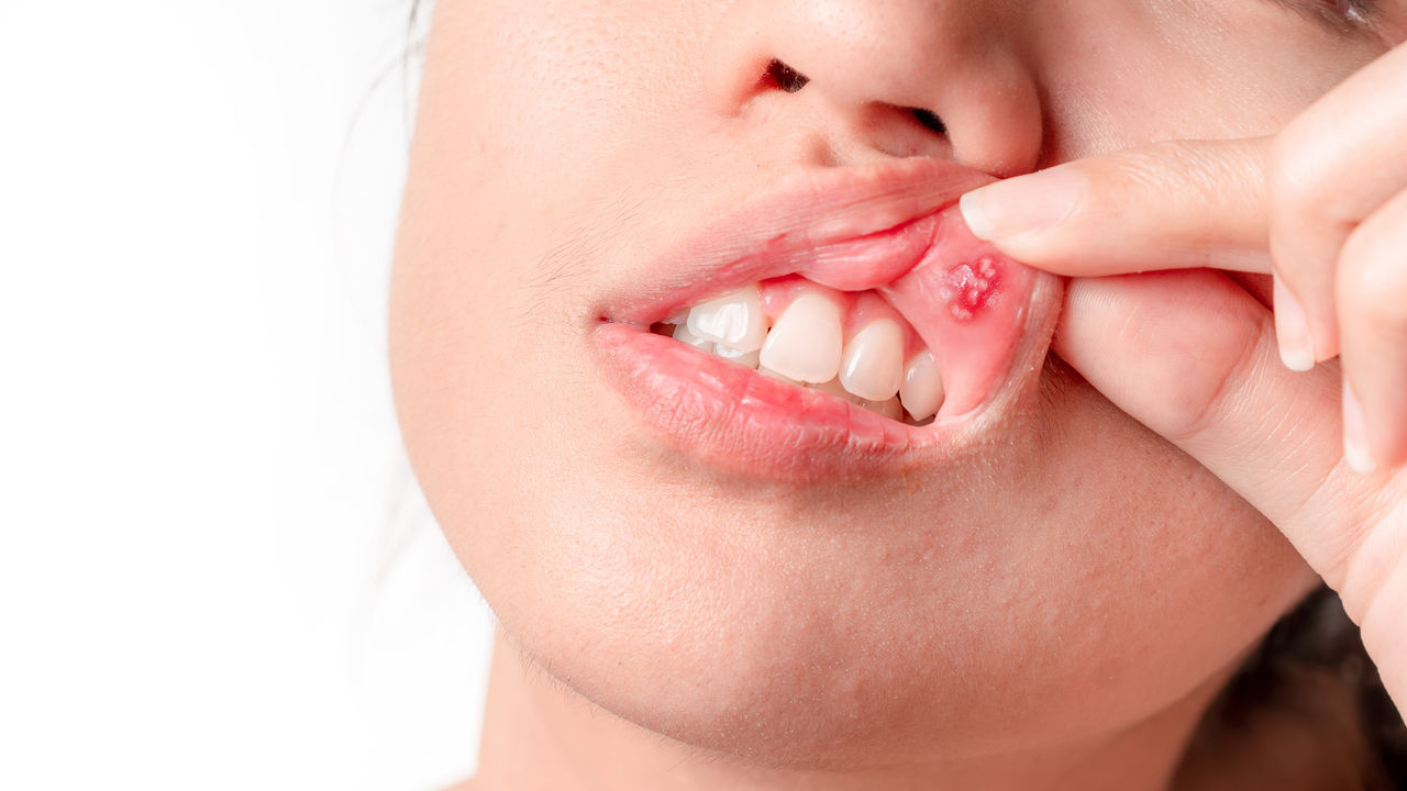 Cosa causa le ulcere alla bocca, come trattarle e come prevenirle